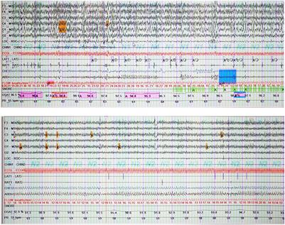 Electro-acupuncture on Vascular Parkinsonism with multiple sleep disorders: A Case Report